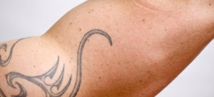 Unveiling the Truth: Does Laser Tattoo Removal Lead to Cancer