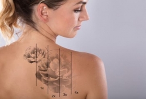 Tattoo Removal Techniques: Comparing Options