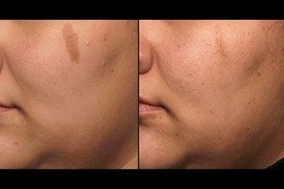 Erase Imperfections: Pico Laser Facial Renewa